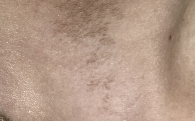 Verkleuring in de hals