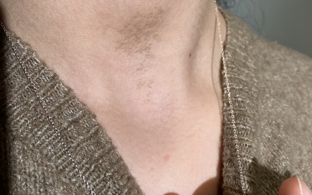 Verkleuring in de hals