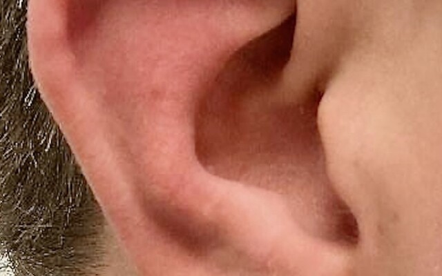 Oorschelp met afwijking