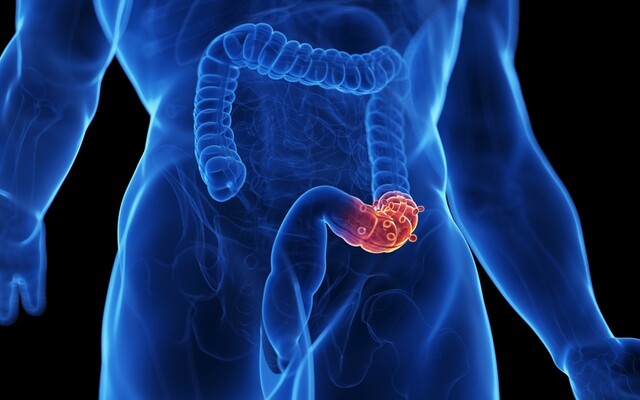 Illustratie van een afwijking in de dikke darm