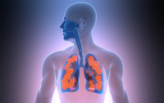 Illustratie van longen met een aandoening