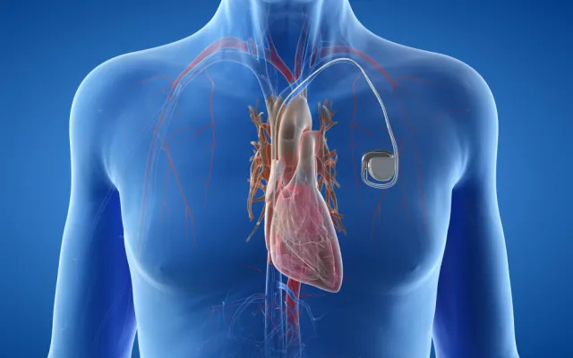 defecte icd-draden Biotronik; NTVG en Investico stellen: zorgsysteem faalt