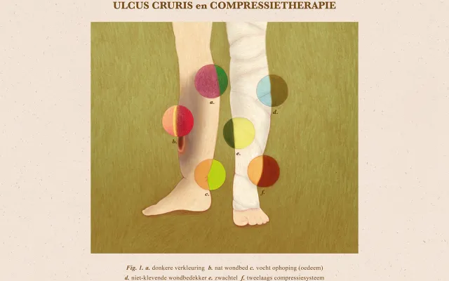 Illustratie met benen met ulcus cruris