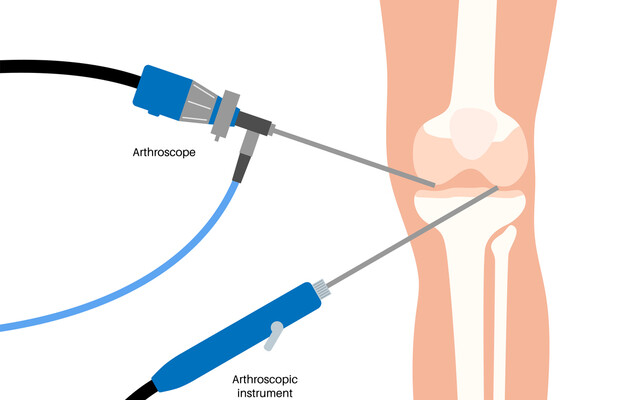 Illustratie van een arthroscopie van de knie