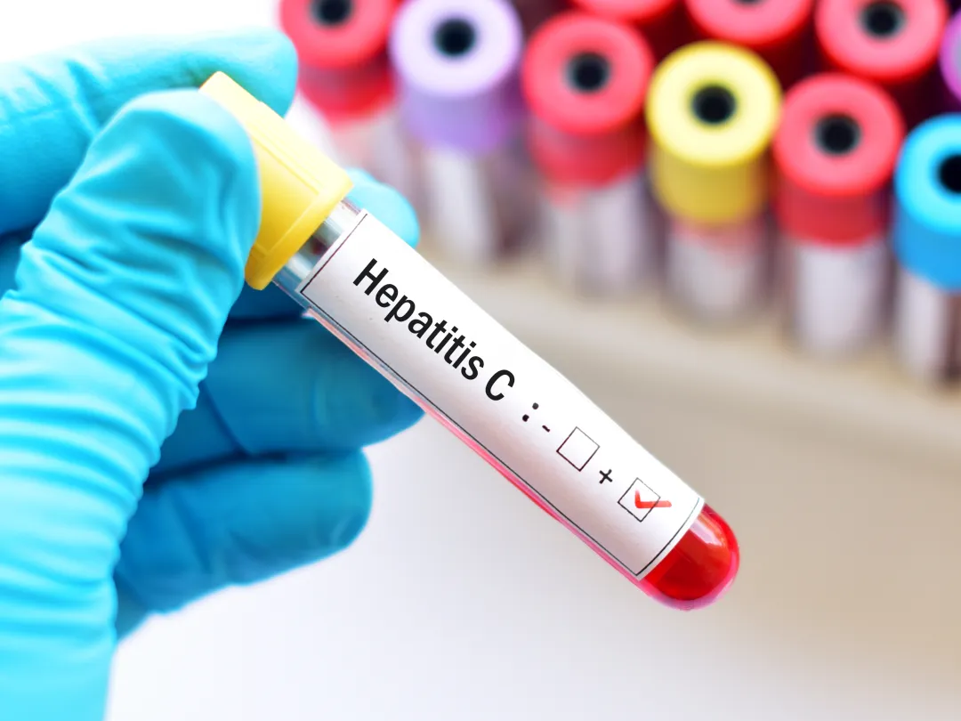 Op een buisje staat 'Hepatitis C'.