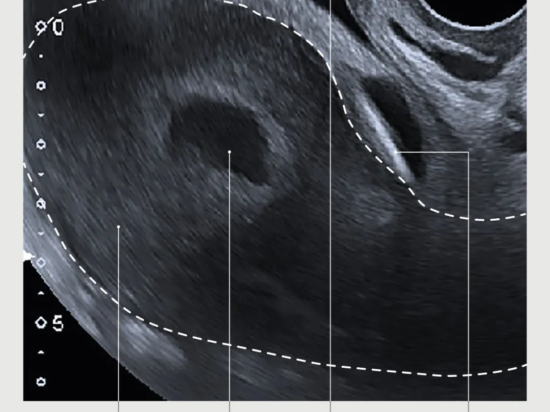 IUD in het cavum Retzii