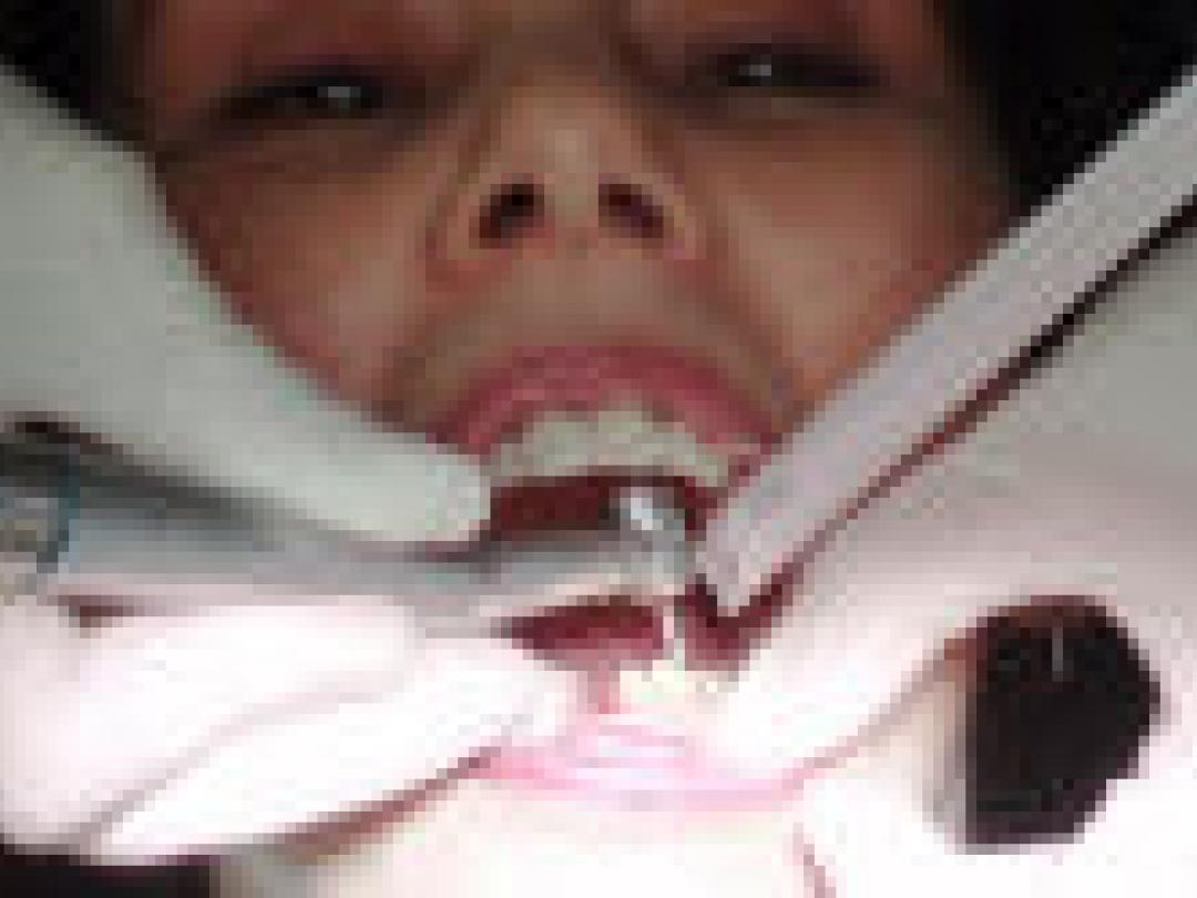 Tandartsen onwetend over bloedingsrisico patiënten