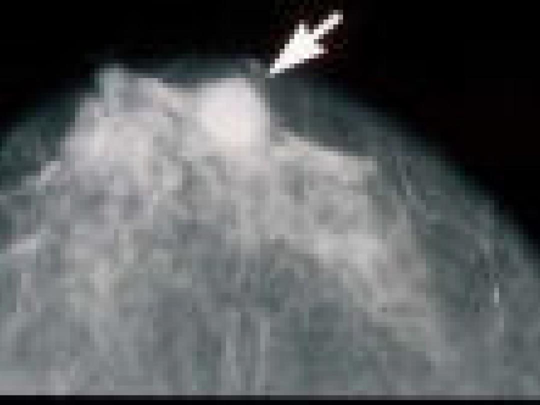 Veel borstkanker gemist, maar weinig claims