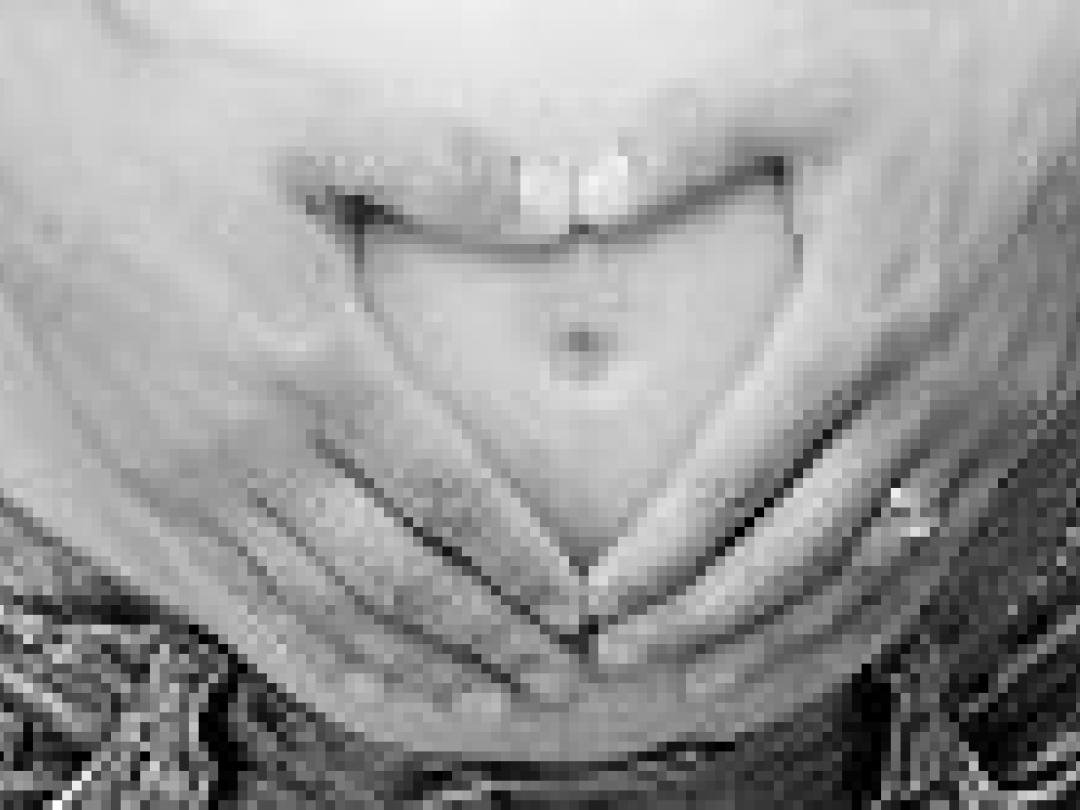 Na pre-eclampsie cardiovasculair risico verhoogd