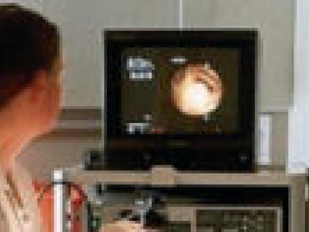 Poliepen weghalen verlaagt sterfte door dikkedarmkanker