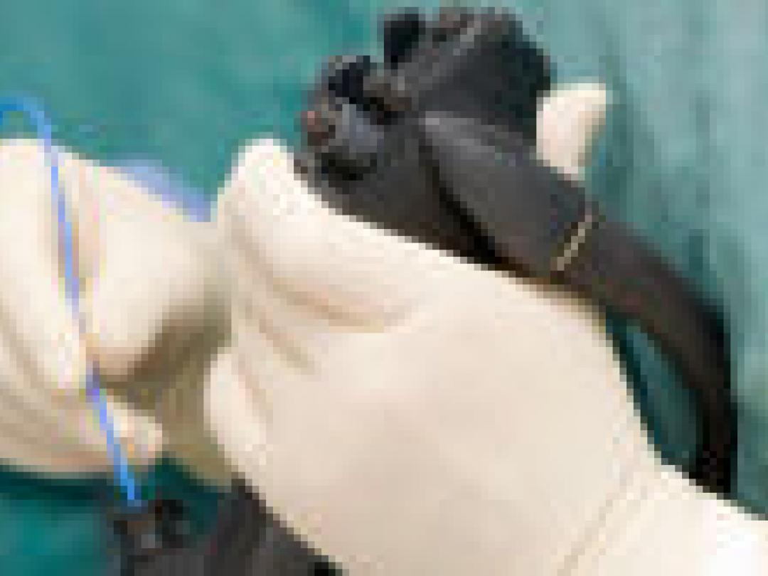 Minder ontsteking na endoscopische necrosectomie bij pancreatitis