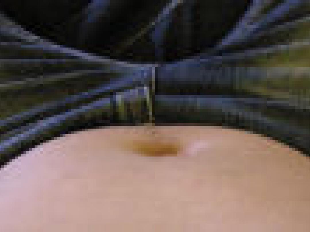 Prikkelbaredarmsyndroom mogelijk niet geassocieerd met ontsteking