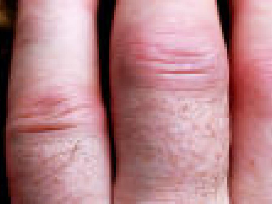 Vroege radiologische schade voorspellend voor beloop RA