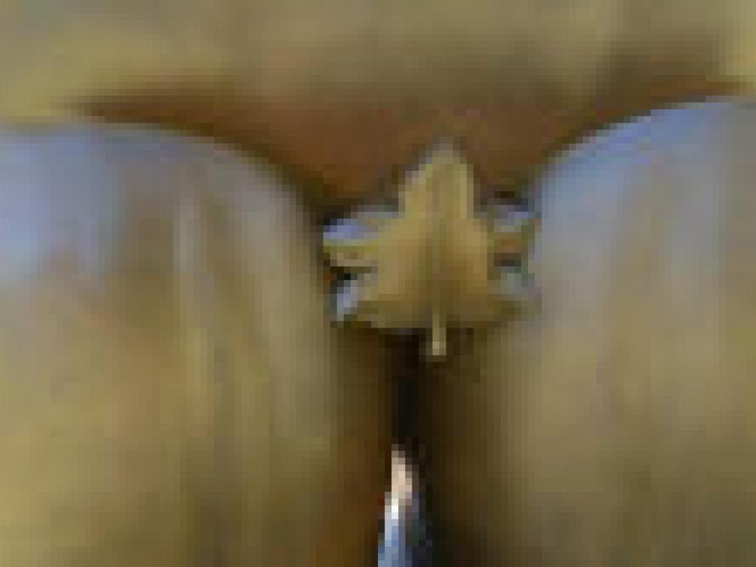 Intratesticulaire varicocele veelvoorkomend na orchidopexie