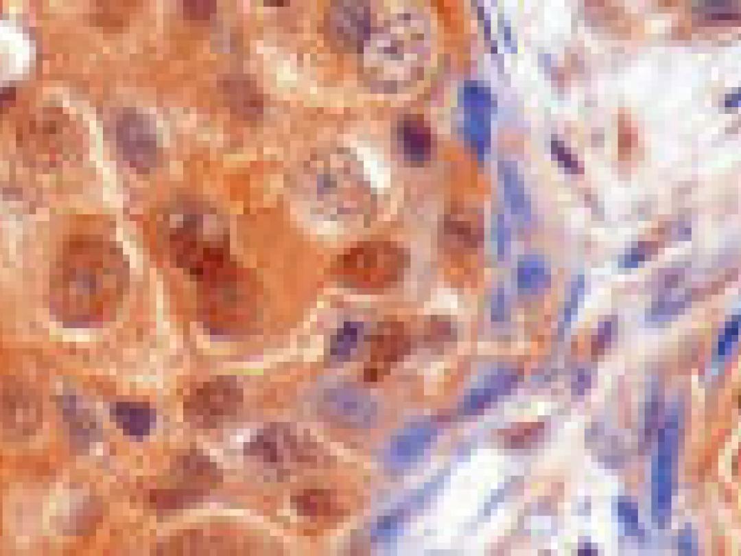 Veel genetische variatie in borsttumor