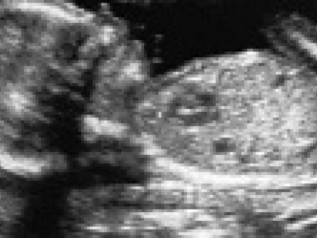 Vaginale bloedingen voorspellen pre-eclampsie niet