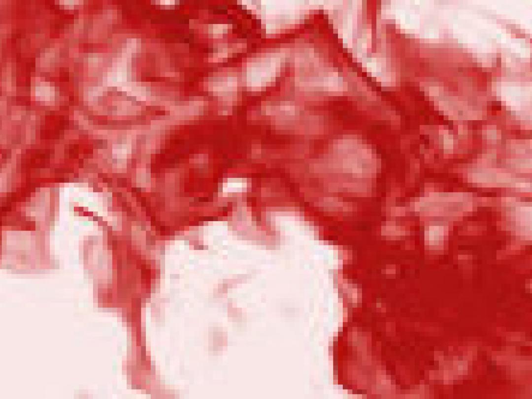 Hiv-behandeling verhoogt risico op intracraniële bloedingen bij hemofilie