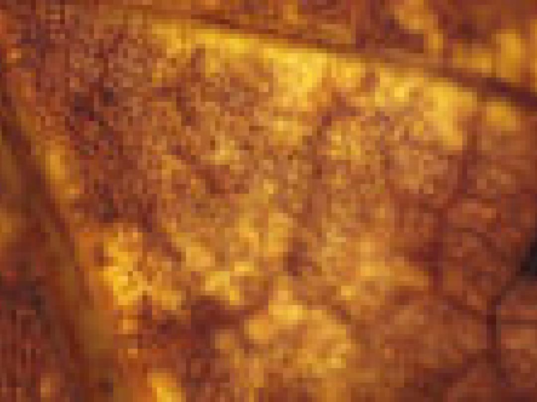 Vasculair risico ook na bypass hoog bij slagaderverkalking