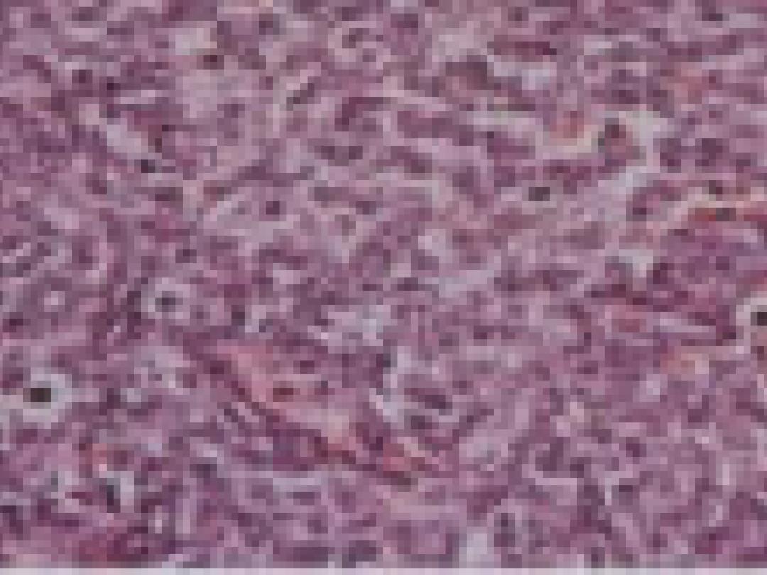 R-CHOP beter bij oudere met mantelcellymfoom