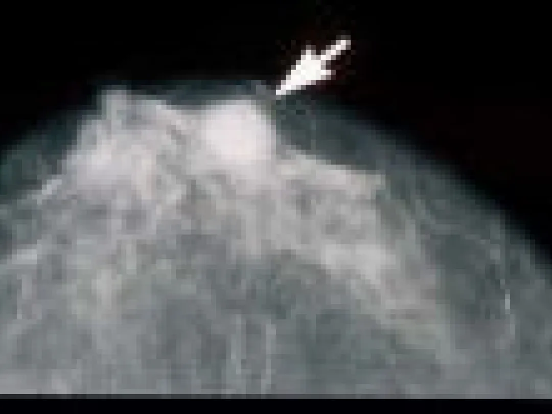 Met BRCA-mutatie kan mammogram juist tot borstkanker leiden