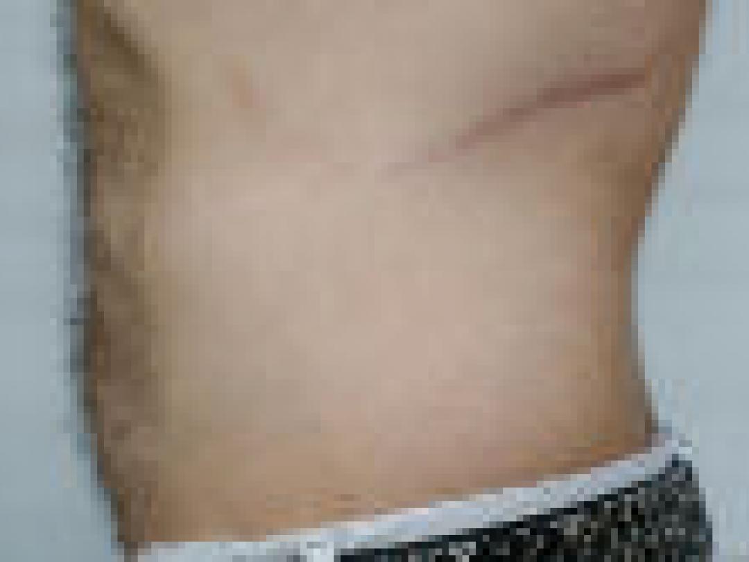 Toename minimaal invasieve chirurgie bij levende nierdonoren