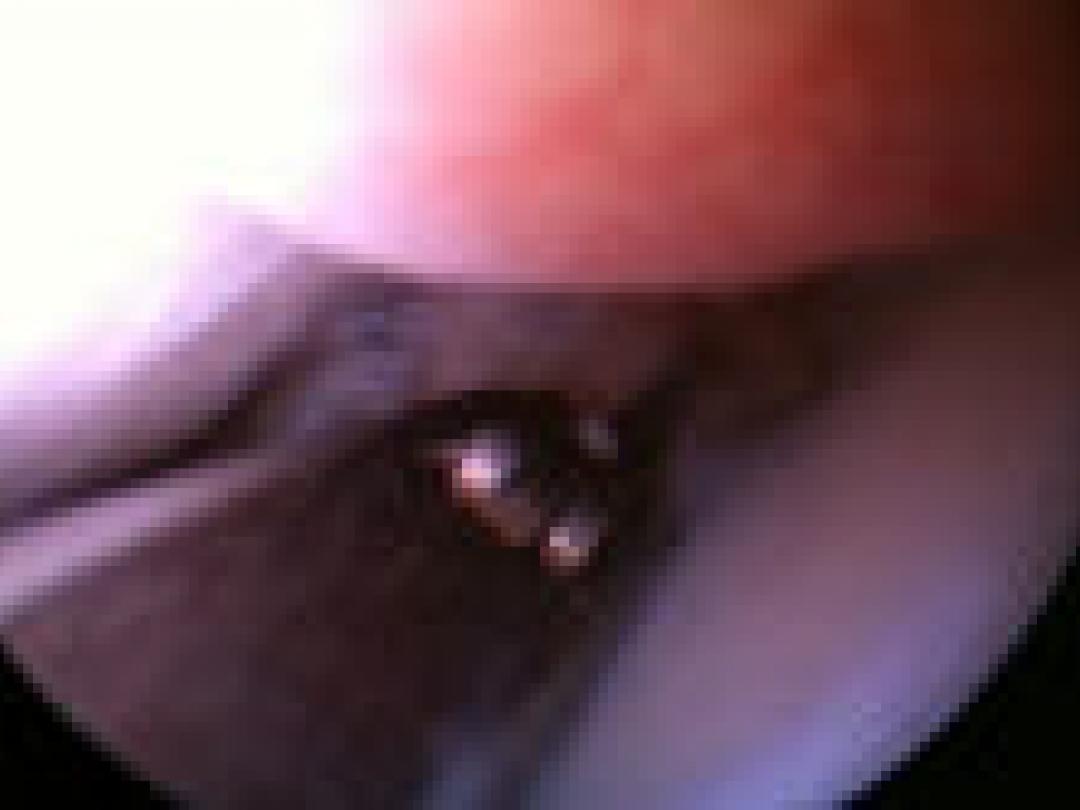 Onderzoek naar kunstmeniscus moet breder