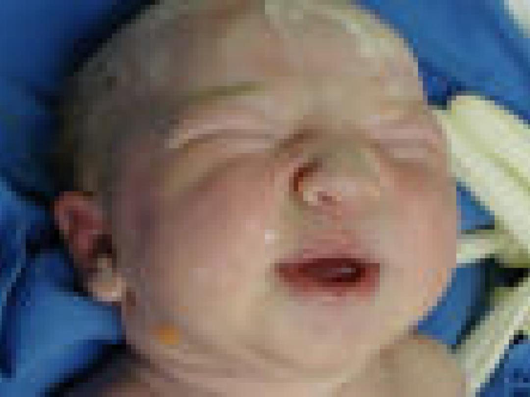 Kinderen met ademhalingsproblemen door opiaten