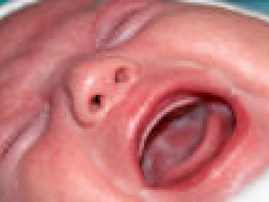 Afwijkend microbioom bij huilbabies