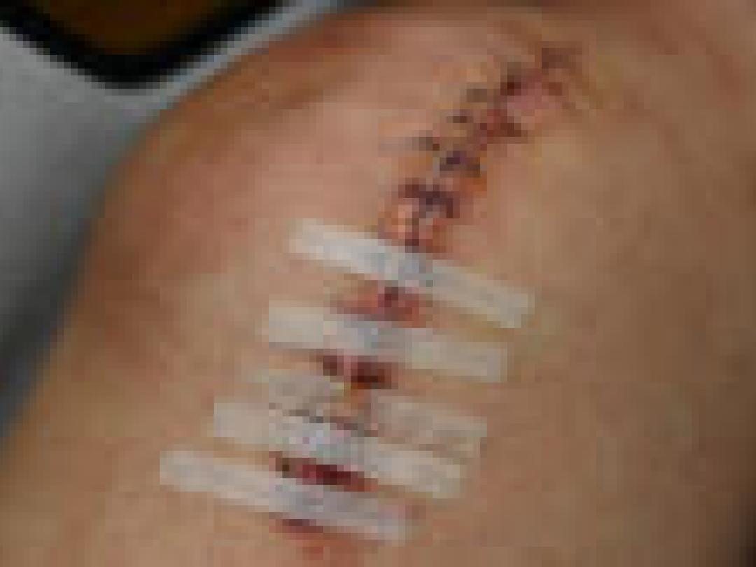 Geen toegevoegde waarde vroeg opereren voorste kruisband