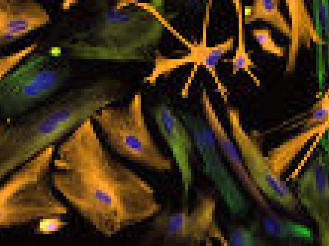 Meer insulten na beroerte bij jonge volwassenen