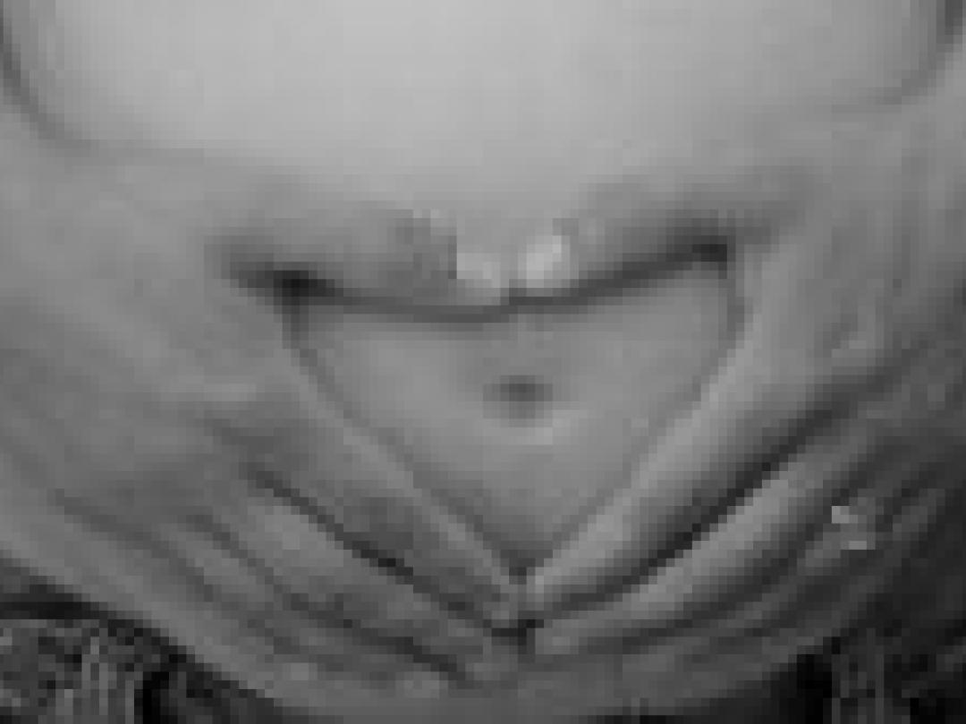 Screening op downsyndroom niet erg populair