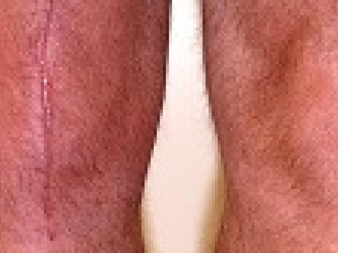 Fysiotherapie soms even goed als direct kijkoperatie