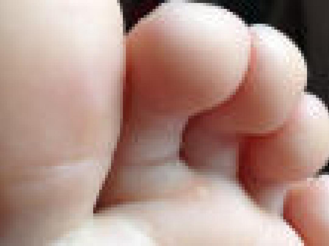 Type virus beïnvloedt beloop voetzoolwratten