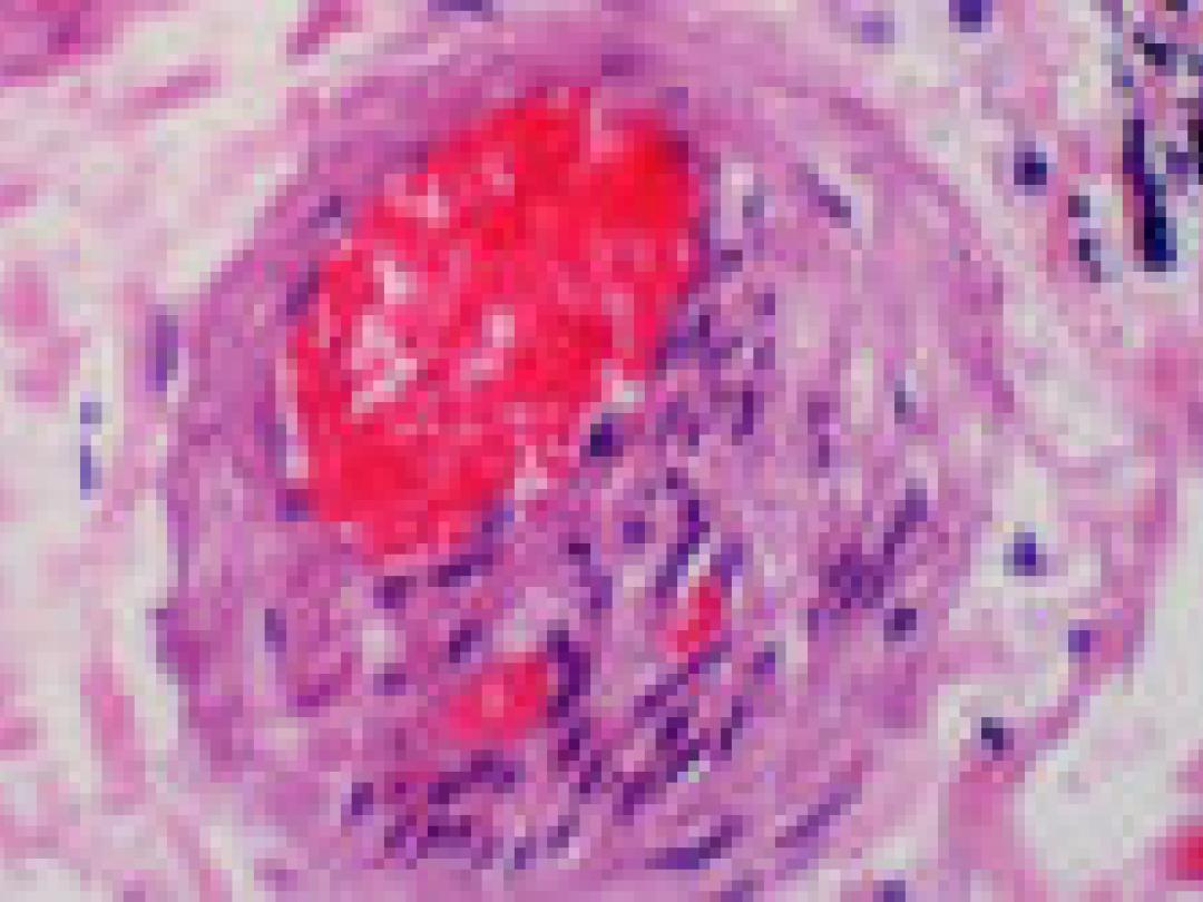 Steroïden verhogen tromboserisico
