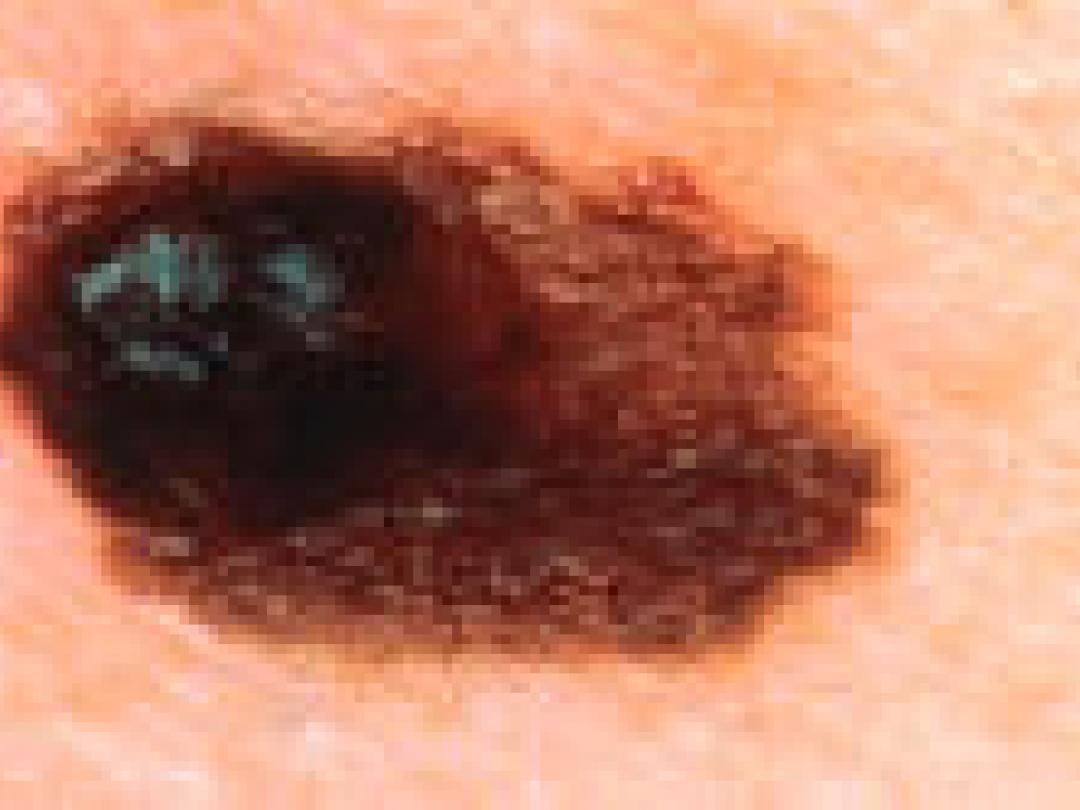 Verhoogd risico op invasief melanoom met TNF-remmer bij reuma