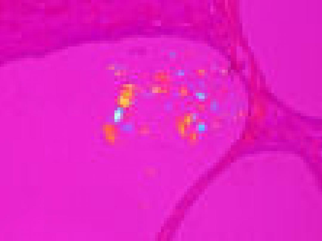 Normogram voor screeningsmammogram