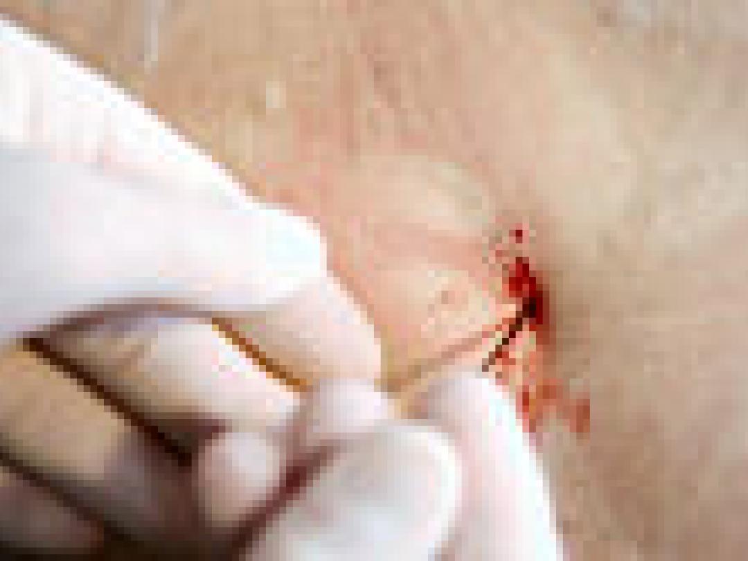 Ruggenprik mogelijk beschermend bij kanker