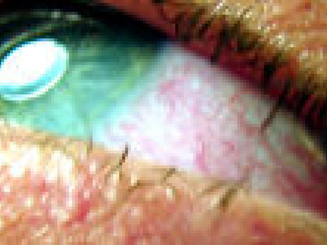 Snelle verslavingstest niet bruikbaar voor screenen op wietverslaving