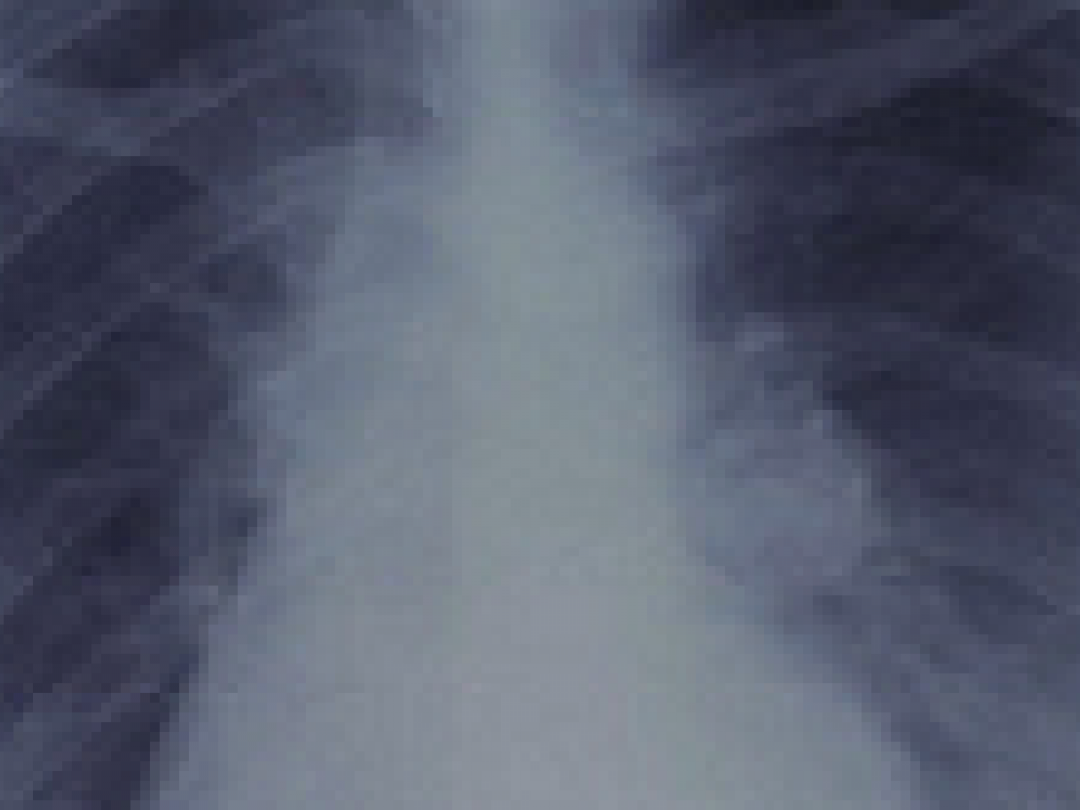 Verhoogde kans op embolie bij longkanker