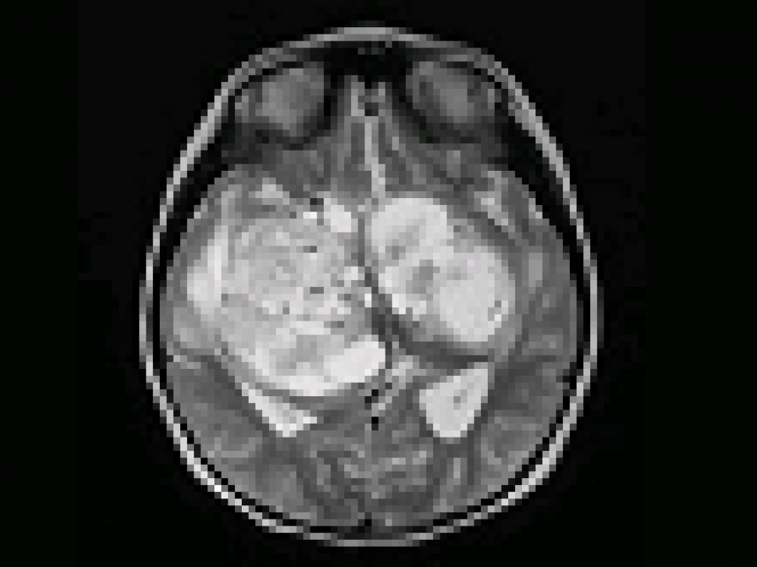 Hersentumor grotere impact op naasten van patiënt