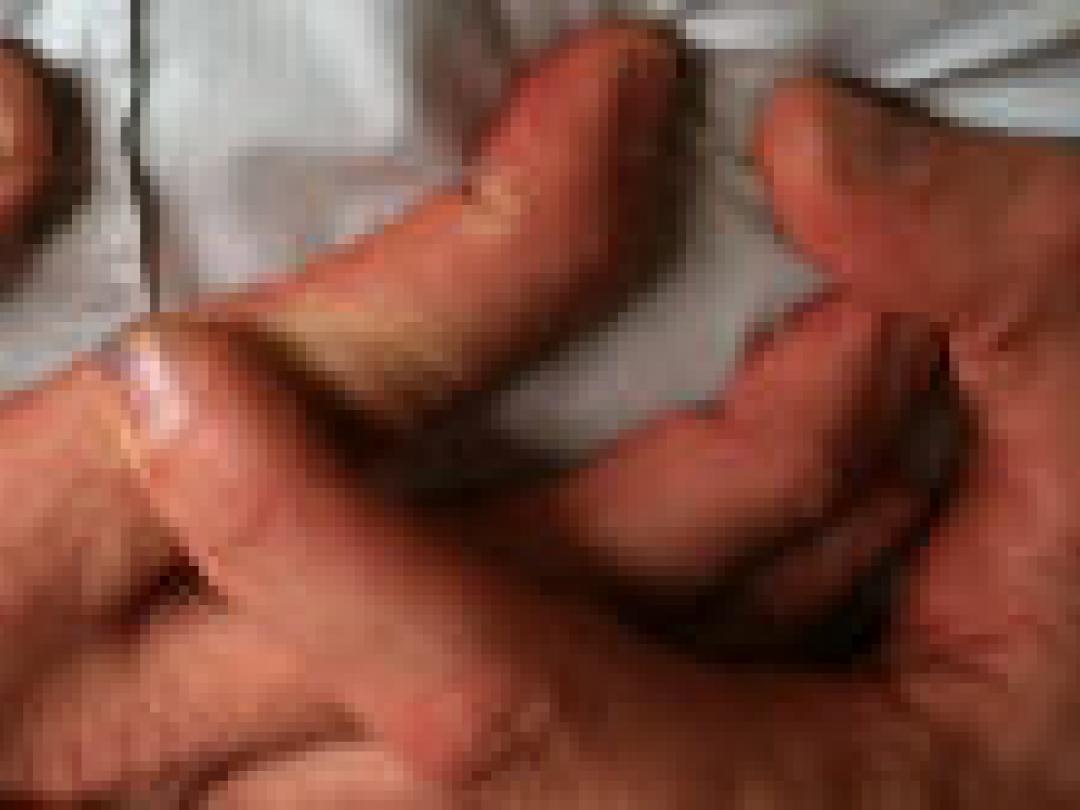 Minder ziekenhuisopnamen voor hartfalen: niet dankzij betere huisartsen