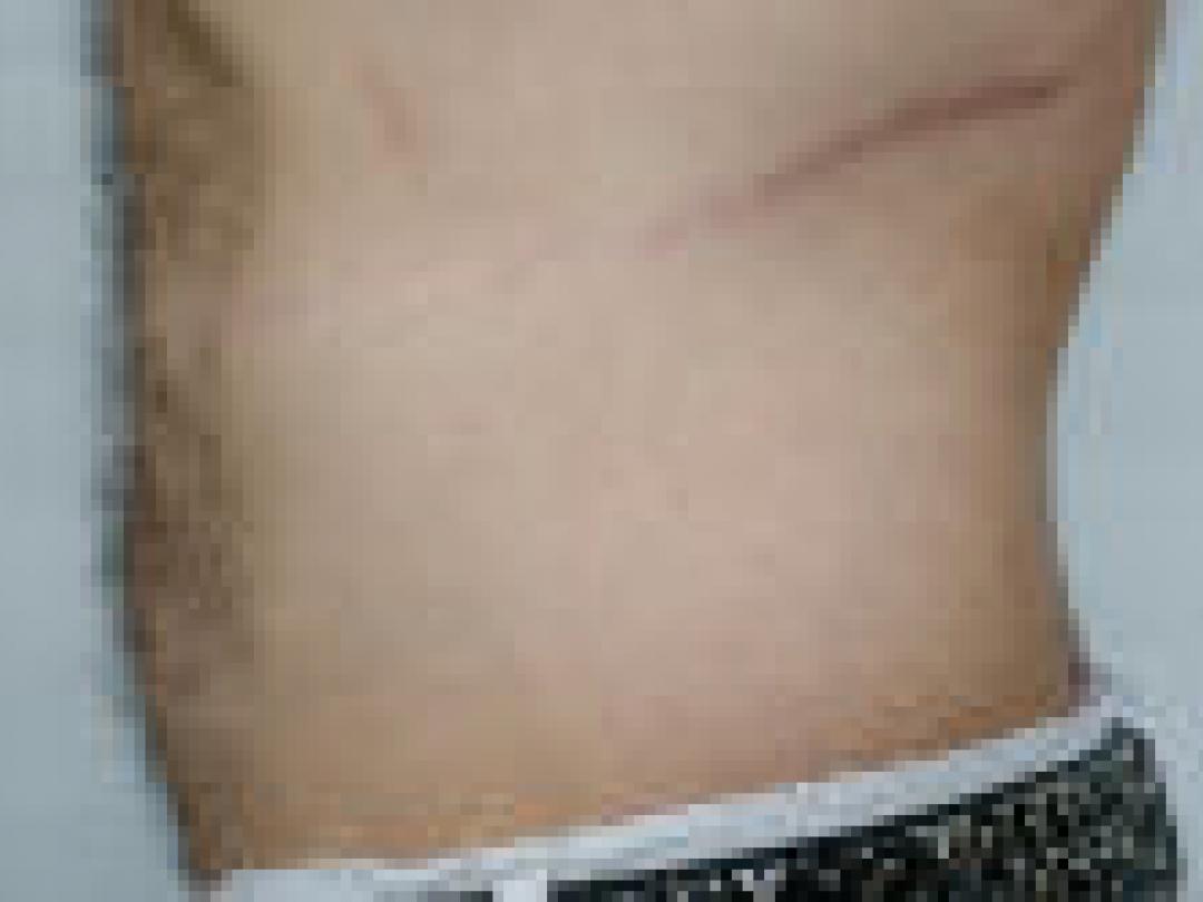 Uitstekende kwaliteit van leven voor oudere nierdonoren