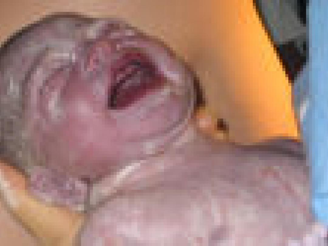 Inleiding van bevalling vergroot kans op sectio niet