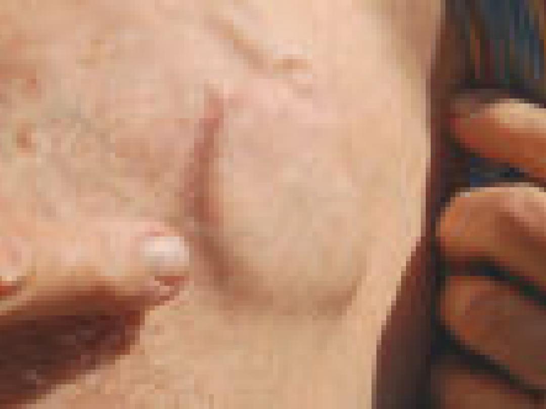 Pacemaker vooral nuttig zonder comorbiditeit