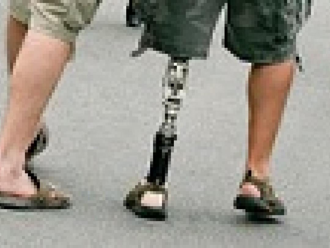 Aanpassing aan kunstbeen beïnvloedt kwaliteit van leven