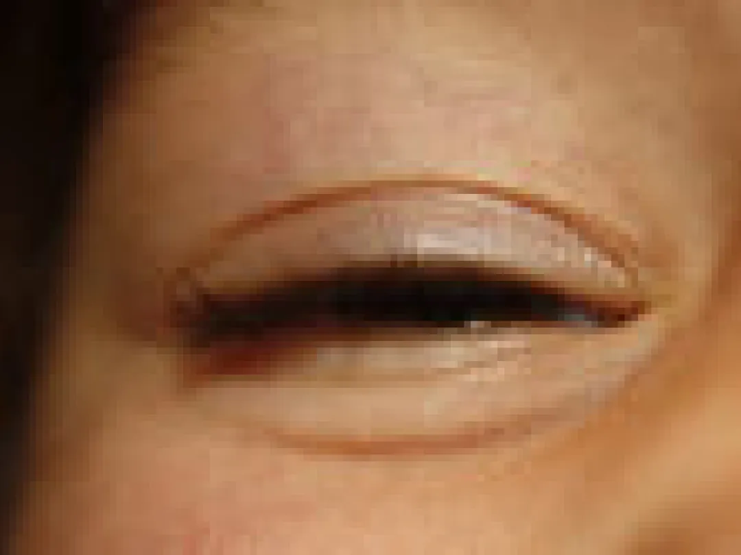 Snelle schifting tussen bacteriële en virale conjunctivitis