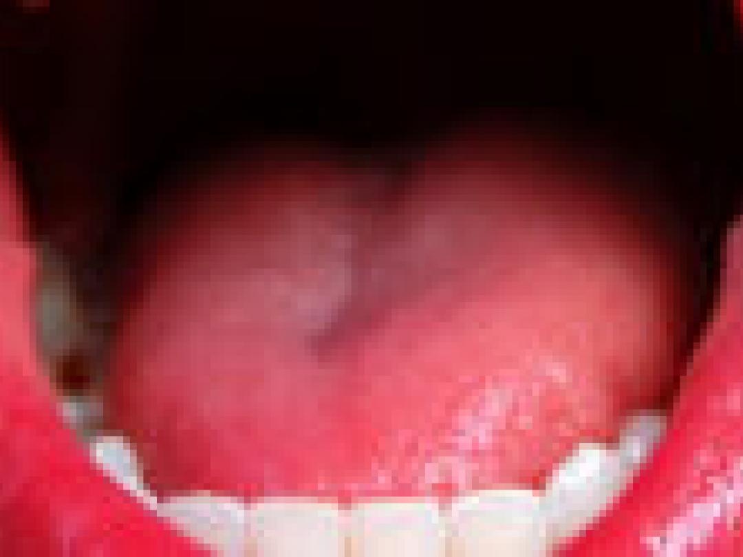 Grieptablet onder de tong mogelijk behulpzaam tijdens grieppandemie