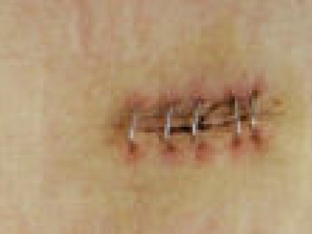 Postoperatieve infecties relatief zeldzaam na dagbehandeling