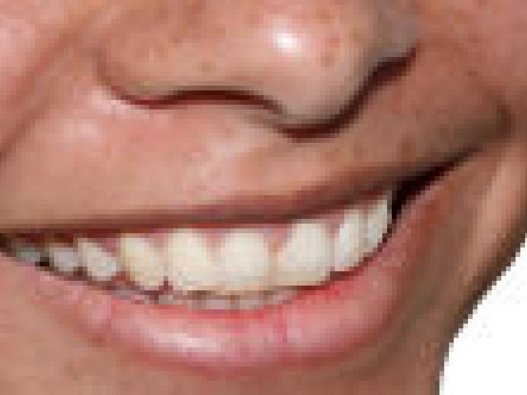 Geen toename gaatjes