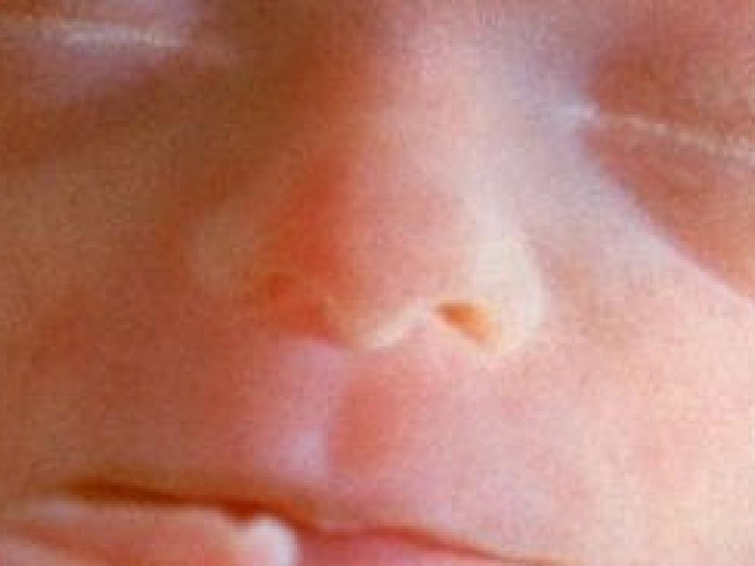 Nieuwe methode foetale chirurgie